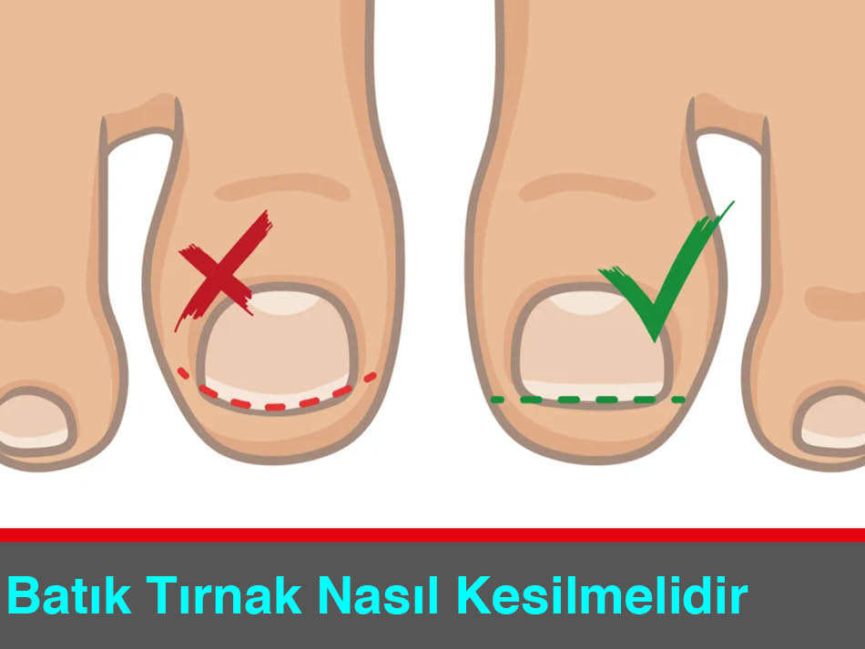 Batık Tırnak Nasıl Kesilmelidir