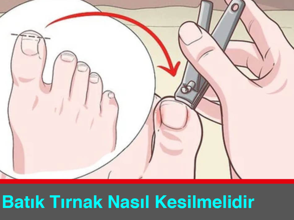 Batık Tırnak Nasıl Kesilmelidir