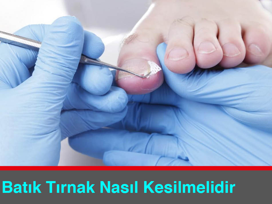 Batık Tırnak Nasıl Kesilmelidir