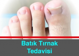 Batık Tırnak Tedavisi Nasıl Yapılır