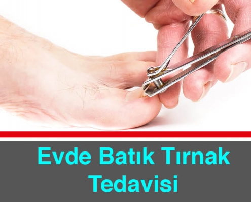 Evde Batık Tırnak Tedavisi Nasıl Yapılır