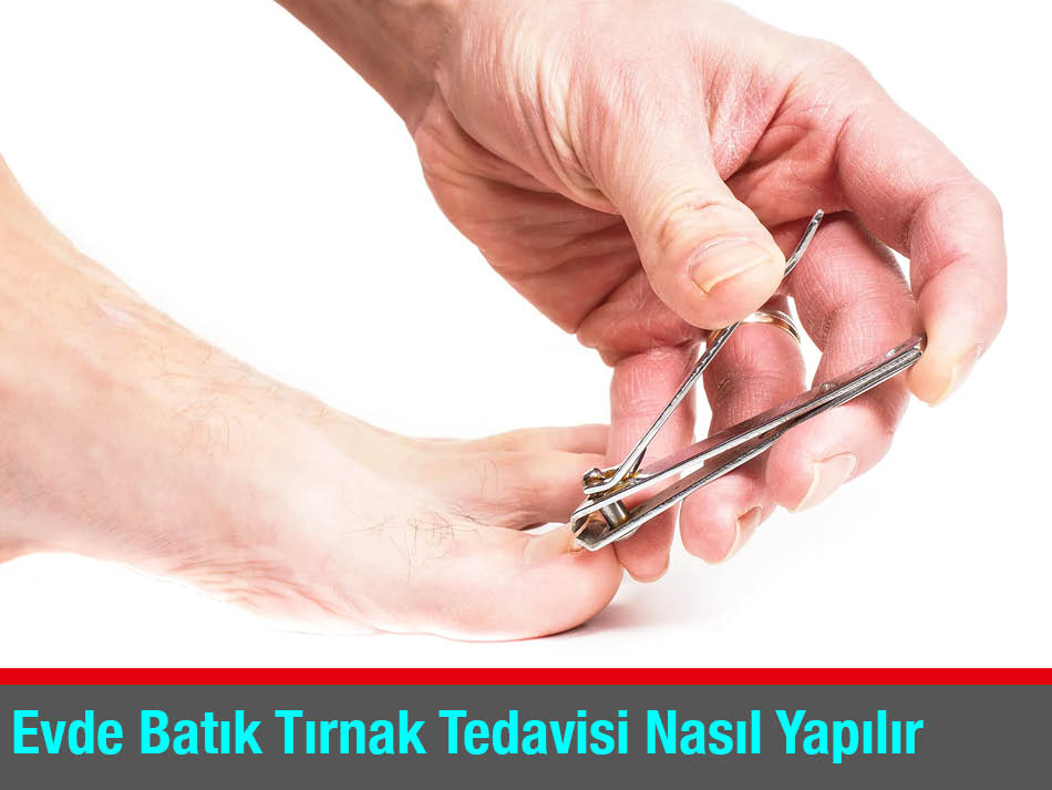 Evde Batık Tırnak Tedavisi Nasıl Yapılır Podoterapi