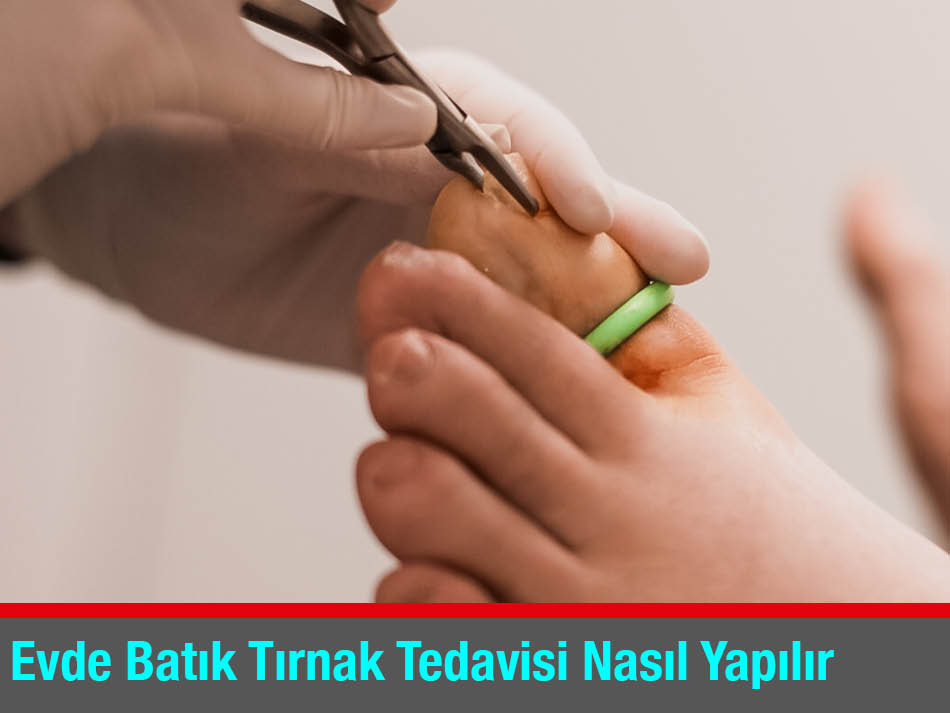 Evde Batık Tırnak Tedavisi Nasıl Yapılır