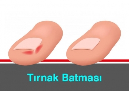 Tırnak Batması Nedir