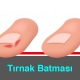 Tırnak Batması Nedir