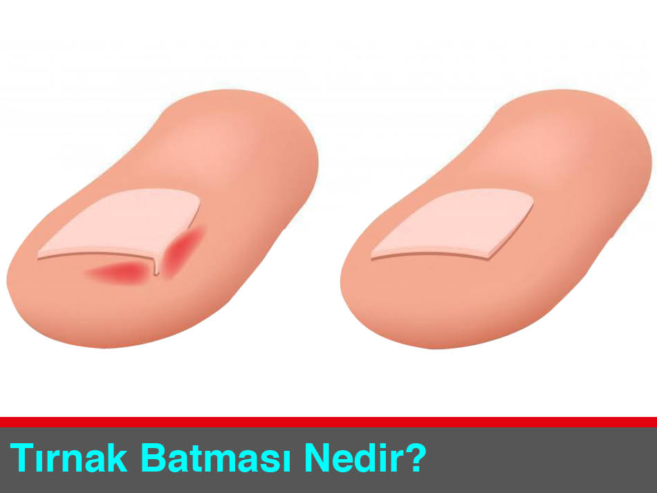 Tırnak Batması Nedir Nasıl Tedavi Edilir