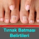 Tırnak Batması Belirtileri Nelerdir