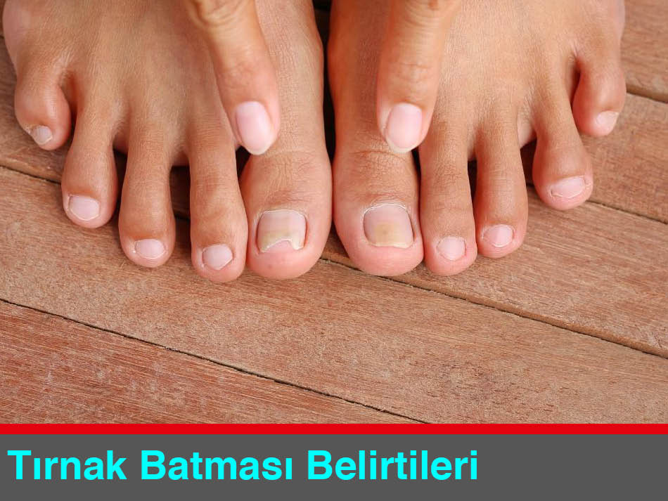 Tırnak Batması Belirtileri Nelerdir