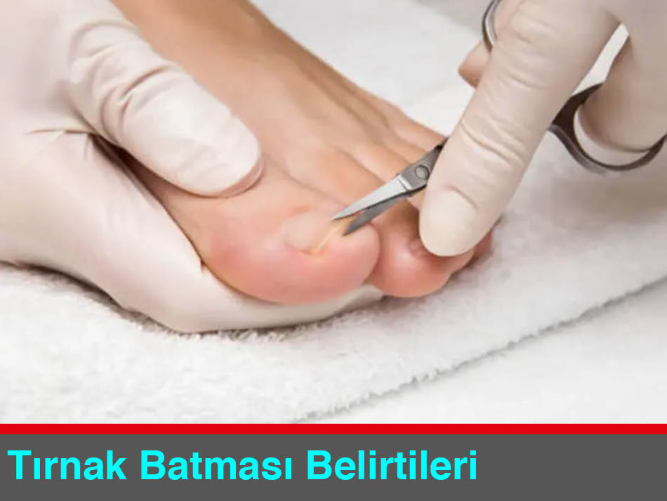 Batık Tırnak Belirtileri Nelerdir