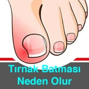 Batık Tırnak Neden Olur Nasıl Önlenir