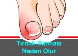 Batık Tırnak Neden Olur Nasıl Önlenir