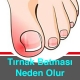 Batık Tırnak Neden Olur Nasıl Önlenir