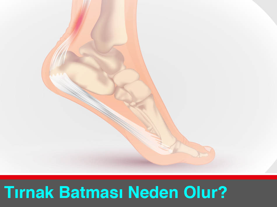 Tırnak Batması Nasıl Önlenir