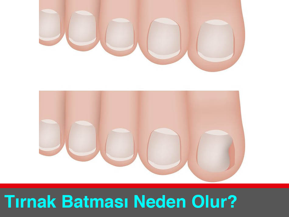 Batık Tırnak Nasıl Önlenir